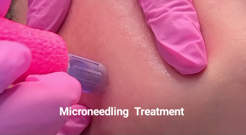 Microneedling